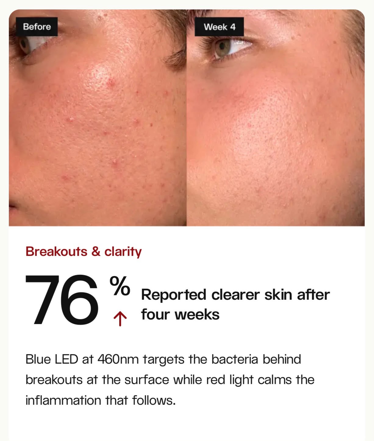 Before and after: 76% clearer skin at week 4