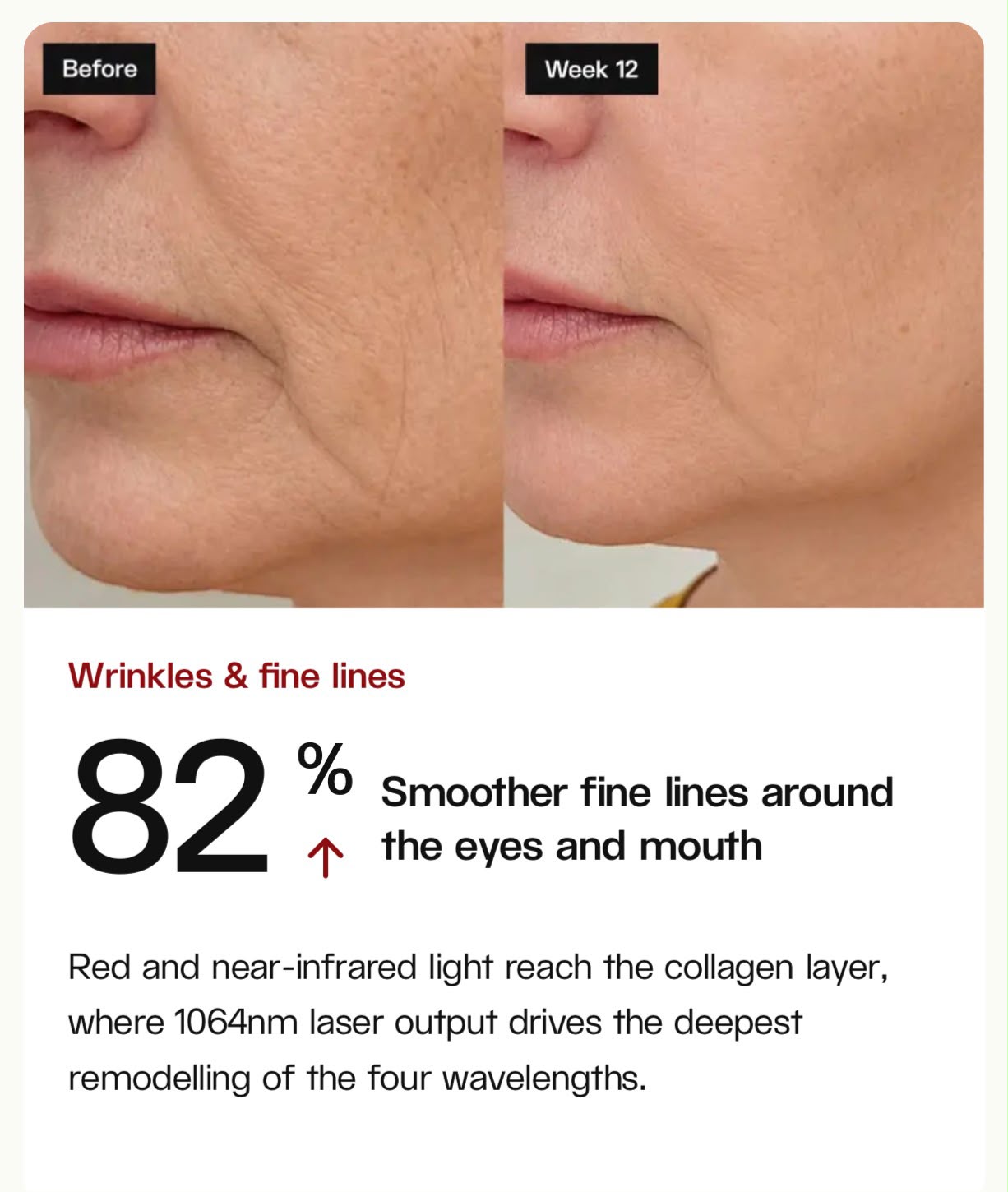 Before and after: 82% smoother fine lines at week 12